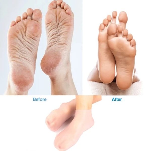 Moisturizing Gel Socks – Heel Crack Repair & Relief